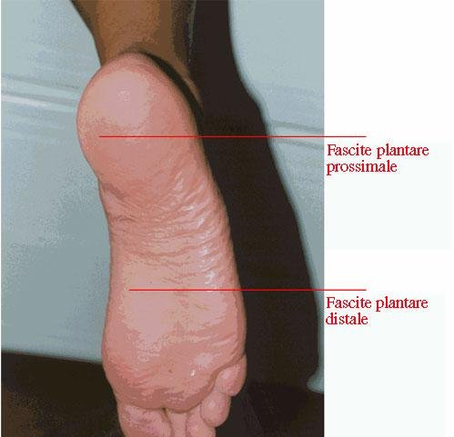 Pianta piede dx con indicazione punti di fascite plantare