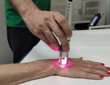 Laserterapia con Klaser per tendinite estensori del carpo eseguita presso Fisiobaso Centro di fisioterapia a Ciampino